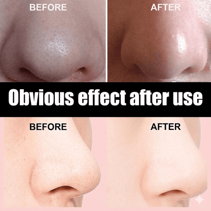 Blackhead Remover Nose Strips - 10 Pack Deep Pore Cleansing Patches